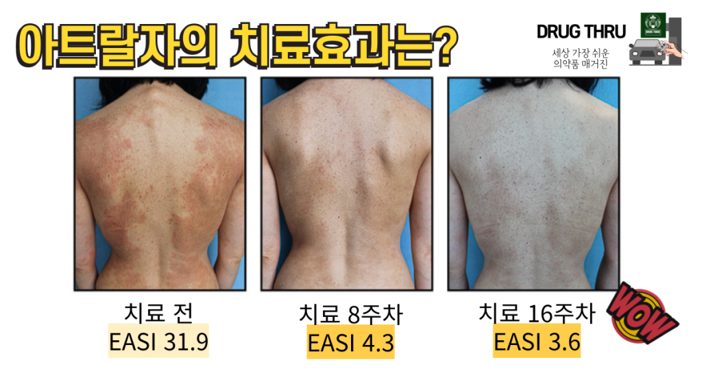 아트랄자-아토피치료효과-임상결과