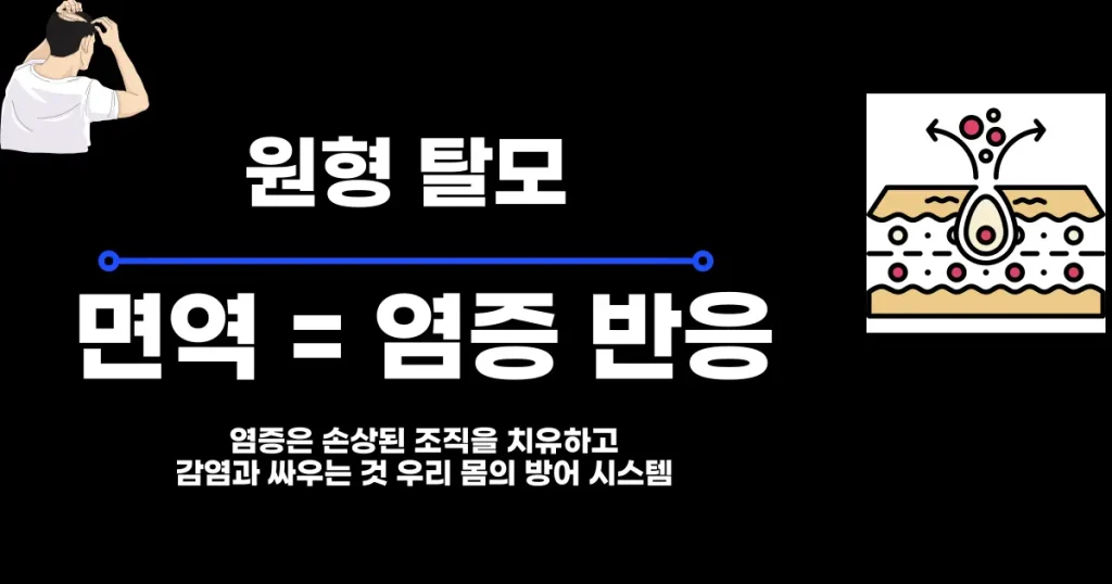 원형탈모-염증-면역억제