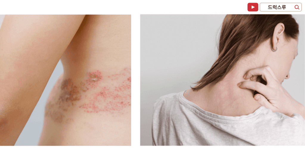 대상포진-통증-특징