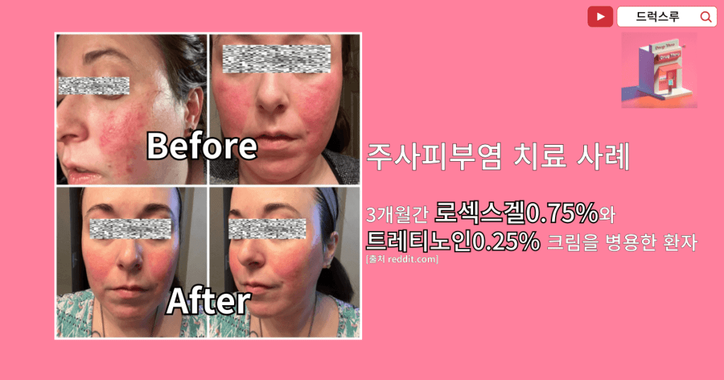 로섹스겔 효과와 주사피부염 치료