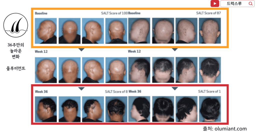 원형탈모-치료-후기-올루미언트-효과