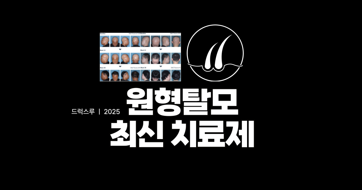 원형탈모-최신-치료제-올루미언트정