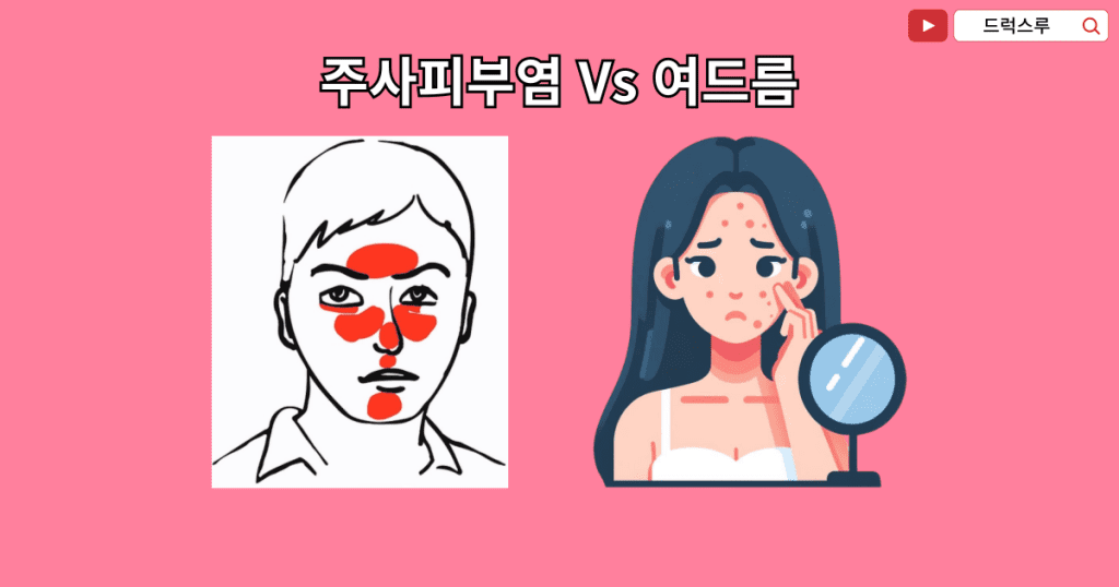 여드름과 주사피부염 차이