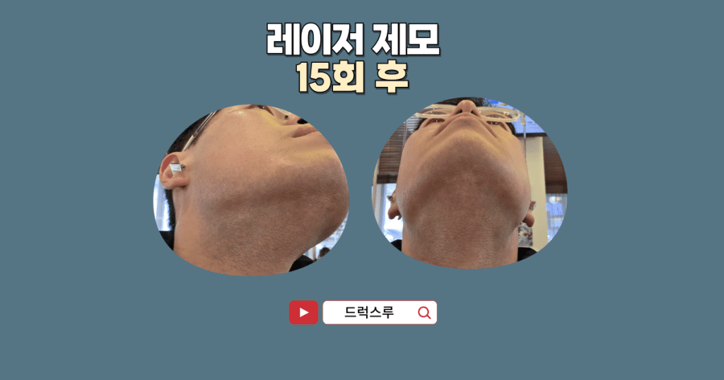 강남-레이저-제모-후기