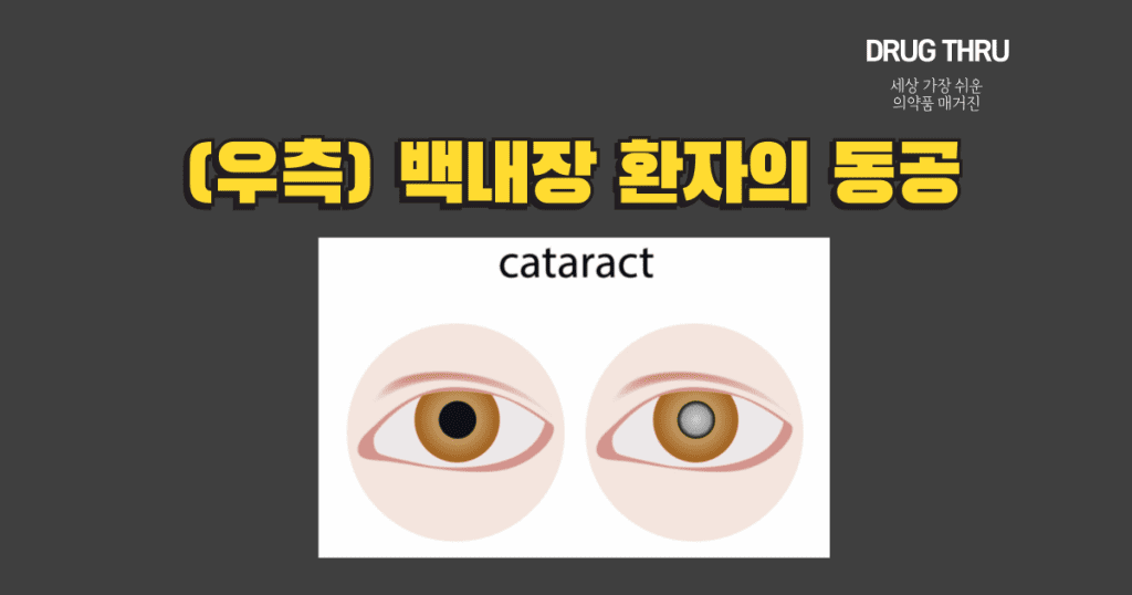 노안-백내장-cataract