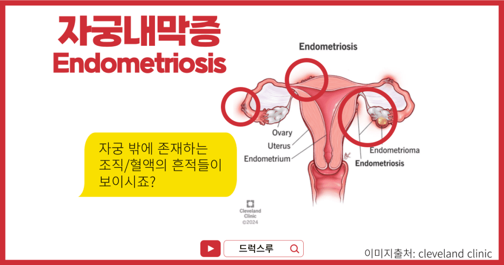 자궁내막증 검사 및 원인 가이드
