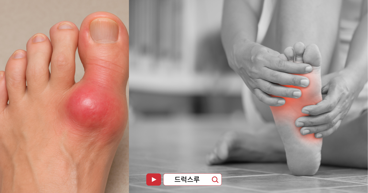 자이로릭-통풍-치료-통풍원인