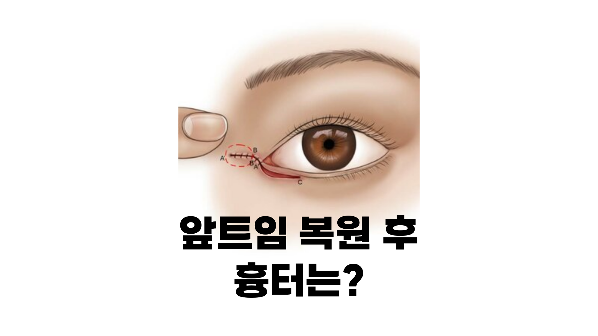 앞트임-복원-흉터-치료제-흉터제거방법